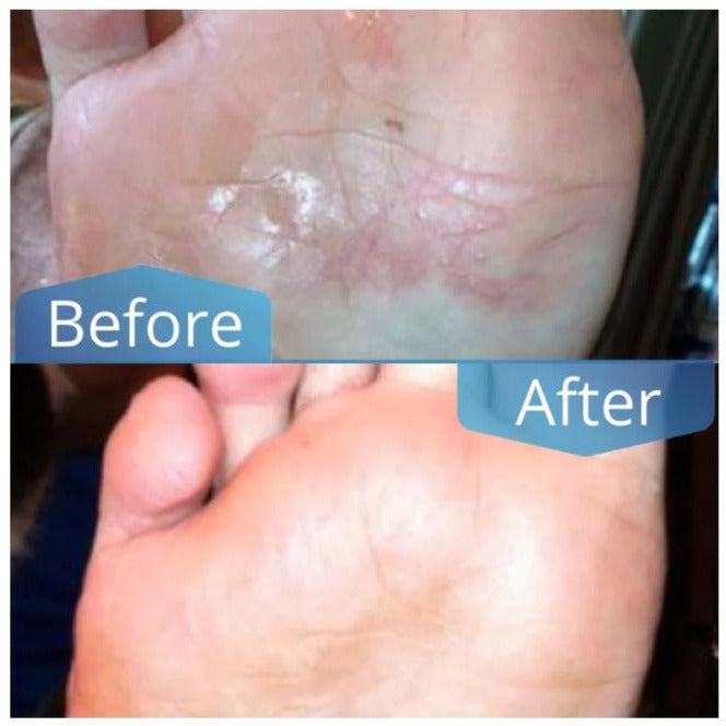 Imperial Feet Athlete's Foot Solution