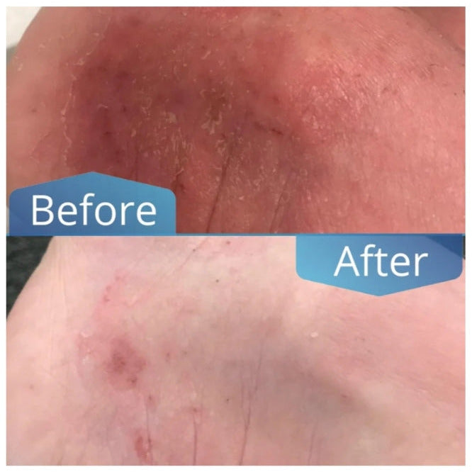 Imperial Feet Urea Balm