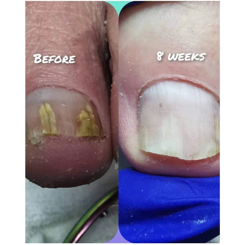 Imperial Feet Nail Mycosis 75ml