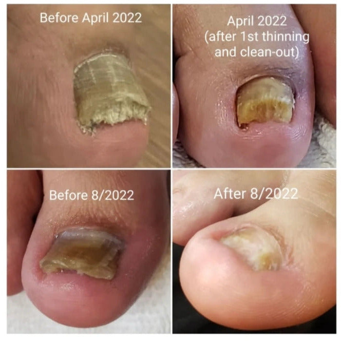 Imperial Feet Nail Mycosis 75ml