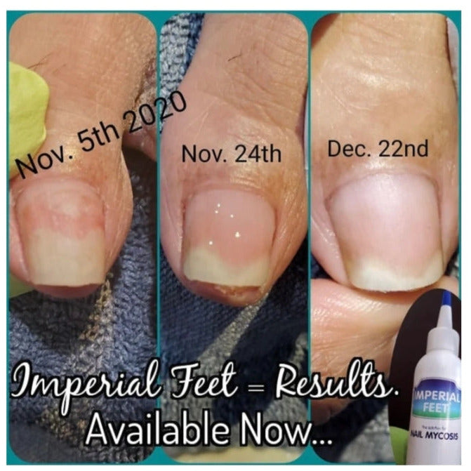 Imperial Feet Nail Mycosis 75ml